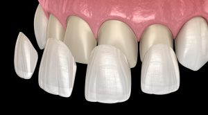 dental veeners