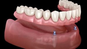 full mouth reconstruction