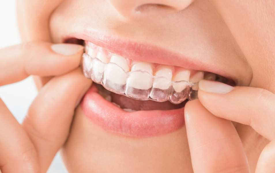 What is Invisalign – woman placing clear Invisalign aligners on her teeth