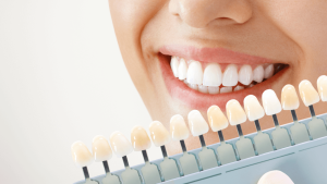 teeth whitening