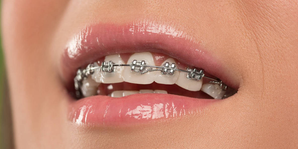 braces