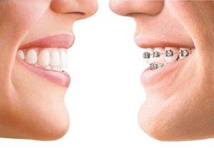 Invisalign vs braces