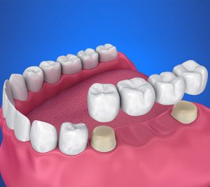 Dental Bridge