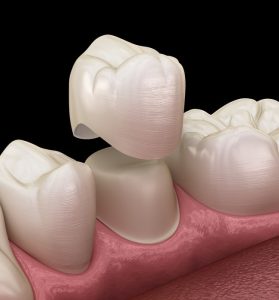 Crowns for Teeths